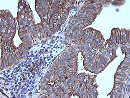 TRIM38 Antibody - IHC of paraffin-embedded Adenocarcinoma of Human ovary tissue using anti-TRIM38 mouse monoclonal antibody.