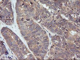 TRIM38 Antibody - IHC of paraffin-embedded Adenocarcinoma of Human ovary tissue using anti-TRIM38 mouse monoclonal antibody.