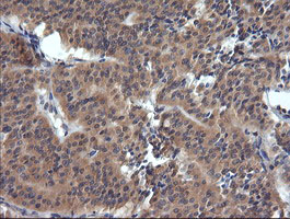 TRIM38 Antibody - IHC of paraffin-embedded Carcinoma of Human thyroid tissue using anti-TRIM38 mouse monoclonal antibody.