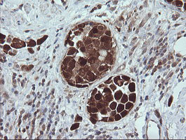 TRIM44 Antibody - IHC of paraffin-embedded Carcinoma of Human bladder tissue using anti-TRIM44 mouse monoclonal antibody.