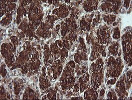 TRIM44 Antibody - IHC of paraffin-embedded Carcinoma of Human liver tissue using anti-TRIM44 mouse monoclonal antibody.