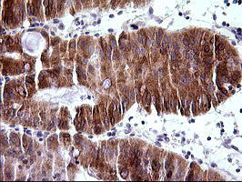 TRIM45 Antibody - IHC of paraffin-embedded Carcinoma of Human pancreas tissue using anti-TRIM45 mouse monoclonal antibody. (Heat-induced epitope retrieval by 10mM citric buffer, pH6.0, 120°C for 3min).