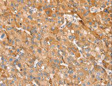 TRIM45 Antibody - Immunohistochemistry of paraffin-embedded Human liver cancer using TRIM45 Polyclonal Antibody at dilution of 1:25.