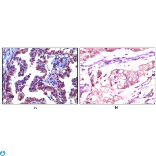 TRIM5 Antibody - Immunohistochemistry (IHC) analysis of paraffin-embedded human metastatic adenocarcinoma(A) and stomach adenocarcinoma (B), showing cytoplasmic localization with AEC staining (A) and DAB staining(B) using TRIM5alpha Monoclonal Antibody.