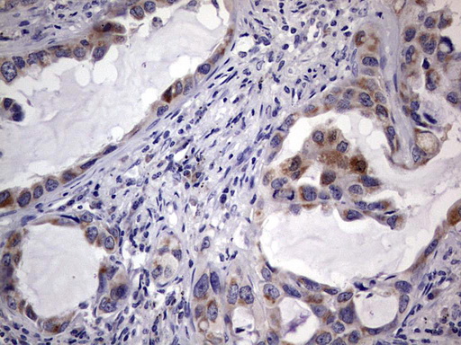 TRIM54 / MURF Antibody - IHC of paraffin-embedded Carcinoma of Human lung tissue using anti-TRIM54 mouse monoclonal antibody. (Heat-induced epitope retrieval by 1 mM EDTA in 10mM Tris, pH8.5, 120°C for 3min).