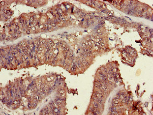 TRIM54 / MURF Antibody - Immunohistochemistry of paraffin-embedded human endometrial cancer at dilution of 1:100