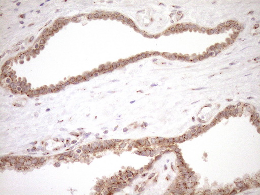 TRIM56 Antibody - Immunohistochemical staining of paraffin-embedded Carcinoma of Human prostate tissue using anti-TRIM56 mouse monoclonal antibody. (Heat-induced epitope retrieval by 1mM EDTA in 10mM Tris buffer. (pH8.5) at 120°C for 3 min. (1:150)