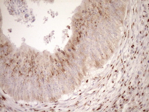 TRIM56 Antibody - Immunohistochemical staining of paraffin-embedded Adenocarcinoma of Human colon tissue using anti-TRIM56 mouse monoclonal antibody. (Heat-induced epitope retrieval by 1mM EDTA in 10mM Tris buffer. (pH8.5) at 120°C for 3 min. (1:150)