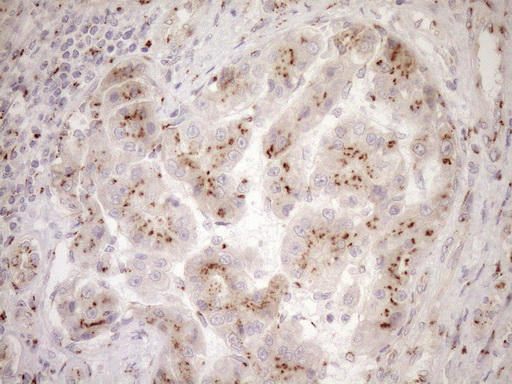 TRIM56 Antibody - Immunohistochemical staining of paraffin-embedded Carcinoma of Human liver tissue using anti-TRIM56 mouse monoclonal antibody. (Heat-induced epitope retrieval by 1mM EDTA in 10mM Tris buffer. (pH8.5) at 120°C for 3 min. (1:150)