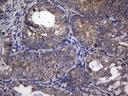 TRIM56 Antibody - Immunohistochemical staining of paraffin-embedded Adenocarcinoma of Human endometrium tissue using anti-TRIM56 mouse monoclonal antibody. (Heat-induced epitope retrieval by 1mM EDTA in 10mM Tris buffer. (pH8.5) at 120°C for 3 min. (1:150)