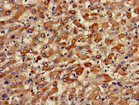 TRIM59 Antibody - Immunohistochemistry of paraffin-embedded human liver cancer using TRIM59 Antibody at dilution of 1:100