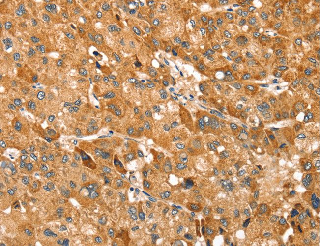 TRIM62 Antibody - Immunohistochemistry of paraffin-embedded Human liver cancer using TRIM62 Polyclonal Antibody at dilution of 1:30.