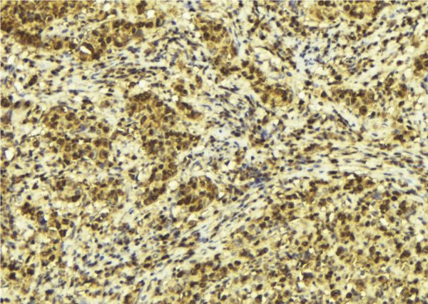 TRIM68 Antibody - 1:100 staining human breast carcinoma tissue by IHC-P. The sample was formaldehyde fixed and a heat mediated antigen retrieval step in citrate buffer was performed. The sample was then blocked and incubated with the antibody for 1.5 hours at 22°C. An HRP conjugated goat anti-rabbit antibody was used as the secondary.