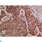 TRIM69 / Trif Antibody - Immunohistochemical analysis of paraffin-embedded human-lung-cancer, antibody was diluted at 1:200.