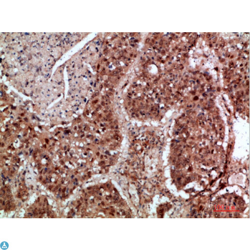 TRIM69 / Trif Antibody - Immunohistochemical analysis of paraffin-embedded human-lung-cancer, antibody was diluted at 1:200.