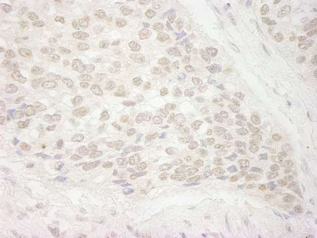 Trimethylguanosine Synthase 1 Antibody - Detection of Human PIMT by Immunohistochemistry. Sample: FFPE section of human non-small cell lung cancer. Antibody: Affinity purified rabbit anti-PIMT used at a dilution of 1:250. Epitope Retrieval Buffer-High pH (IHC-101J) was substituted for Epitope Retrieval Buffer-Reduced pH.