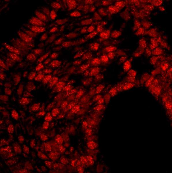Trimethylguanosine Synthase 1 Antibody - Detection of Human PIMT by Immunofluorescence. Sample: FFPE section of human breast carcinoma. Antibody: Affinity purified rabbit anti-PIMT used at a dilution of 1:100. Detection: Red-fluorescent goat anti-rabbit IgG highly cross-adsorbed Antibody used at a dilution of 1:100. Epitope Retrieval Buffer-High pH (IHC-101J) was substituted for Epitope Retrieval Buffer-Reduced pH.