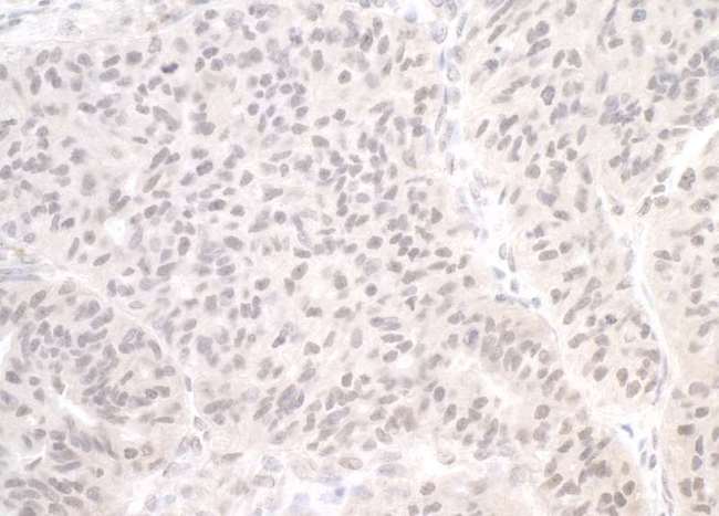Trimethylguanosine Synthase 1 Antibody - Detection of human PIMT by immunohistochemistry. Sample: FFPE section of human ovarian cancer. Antibody: Affinity purified rabbit anti-PIMT used at a dilution of 1:250. Detection: DAB