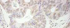 Trimethylguanosine Synthase 1 Antibody - Detection of Human PIMT by Immunohistochemistry. Sample: FFPE section of human colon carcinoma. Antibody: Affinity purified rabbit anti-PIMT used at a dilution of 1:200 (1 ug/ml). Detection: DAB.