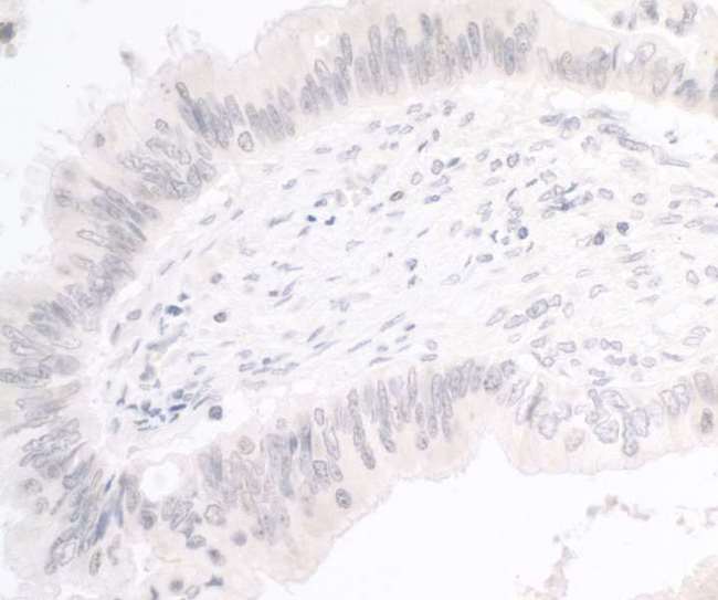 Trimethylguanosine Synthase 1 Antibody - Detection of human PIMT by immunohistochemistry. Sample: FFPE section of human colon carcinoma. Antibody: Affinity purified rabbit anti- PIMT used at a dilution of 1:1,000 (1µg/ml). Detection: DAB