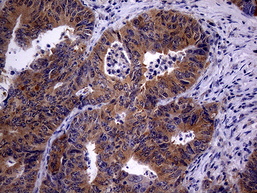 TRIP13 Antibody - Immunohistochemical staining of paraffin-embedded Adenocarcinoma of Human colon tissue using anti-TRIP13 mouse monoclonal antibody. (Heat-induced epitope retrieval by 1mM EDTA in 10mM Tris buffer. (pH8.5) at 120°C for 3 min. (1:2000)