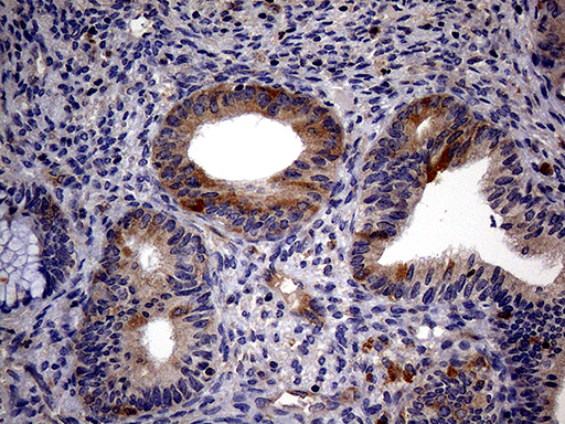 TRIP13 Antibody - Immunohistochemical staining of paraffin-embedded Adenocarcinoma of Human endometrium tissue using anti-TRIP13 mouse monoclonal antibody. (Heat-induced epitope retrieval by 1mM EDTA in 10mM Tris buffer. (pH8.5) at 120°C for 3 min. (1:2000)