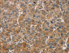 TRIP4 / ASC-1 Antibody - Immunohistochemistry of paraffin-embedded Human gastric cancer using TRIP4 Polyclonal Antibody at dilution of 1:40.