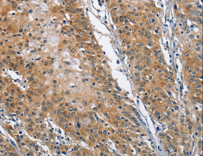 TRIP4 / ASC-1 Antibody - Immunohistochemistry of paraffin-embedded Human gastric cancer using TRIP4 Polyclonal Antibody at dilution of 1:40.