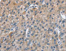 TRIP4 / ASC-1 Antibody - Immunohistochemistry of paraffin-embedded Human liver cancer using TRIP4 Polyclonal Antibody at dilution of 1:50.