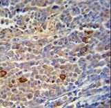 TRMO / C9orf156 Antibody - C9orf156 Antibody immunohistochemistry of formalin-fixed and paraffin-embedded human skin carcinoma followed by peroxidase-conjugated secondary antibody and DAB staining.
