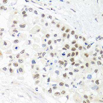 TRMT1 Antibody - Immunohistochemistry of paraffin-embedded human lung cancer tissue.