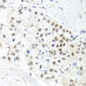 TRMT1 Antibody - Immunohistochemistry of paraffin-embedded human lung cancer tissue.