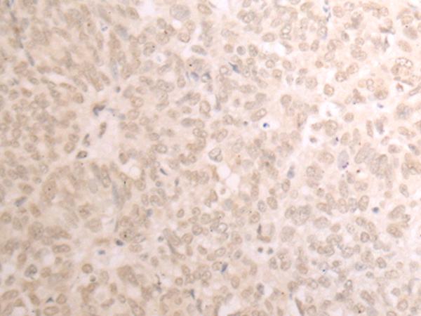 TRMT1 Antibody - Immunohistochemistry of paraffin-embedded Human ovarian cancer tissue  using TRMT1 Polyclonal Antibody at dilution of 1:25(×200)