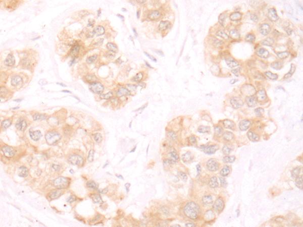 TRMT1 Antibody - Immunohistochemistry of paraffin-embedded Human liver cancer tissue  using TRMT1 Polyclonal Antibody at dilution of 1:25(×200)