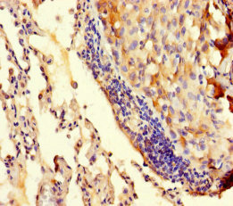 TRMT112 Antibody - Immunohistochemistry of paraffin-embedded human lung cancer using TRMT112 Antibody at dilution of 1:100