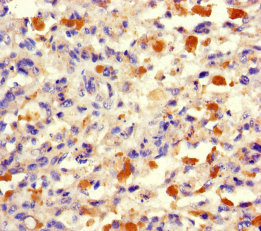 TRMT112 Antibody - Immunohistochemistry of paraffin-embedded human melanoma using TRMT112 Antibody at dilution of 1:100
