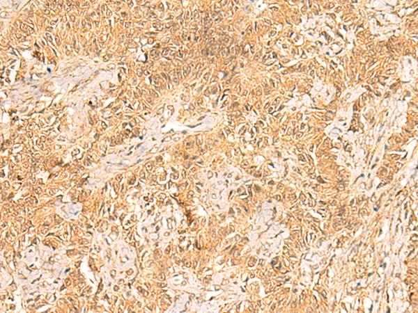 TRMT112 Antibody - Immunohistochemistry of paraffin-embedded Human ovarian cancer tissue  using TRMT112 Polyclonal Antibody at dilution of 1:30(×200)