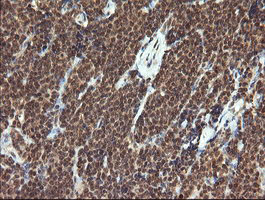 TRMT2A Antibody - IHC of paraffin-embedded Human lymphoma tissue using anti-TRMT2A mouse monoclonal antibody. (Heat-induced epitope retrieval by 10mM citric buffer, pH6.0, 120°C for 3min).