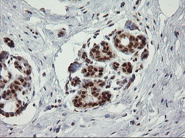 TRMT2A Antibody - IHC of paraffin-embedded Human breast tissue using anti-TRMT2A mouse monoclonal antibody.