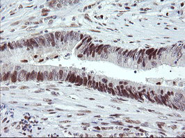 TRMT2A Antibody - IHC of paraffin-embedded Adenocarcinoma of Human colon tissue using anti-TRMT2A mouse monoclonal antibody.