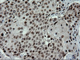 TRMT2A Antibody - IHC of paraffin-embedded Carcinoma of Human lung tissue using anti-TRMT2A mouse monoclonal antibody.