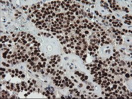 TRMT2A Antibody - IHC of paraffin-embedded Carcinoma of Human pancreas tissue using anti-TRMT2A mouse monoclonal antibody.