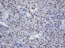TRMT2A Antibody - IHC of paraffin-embedded Carcinoma of Human thyroid tissue using anti-TRMT2A mouse monoclonal antibody.