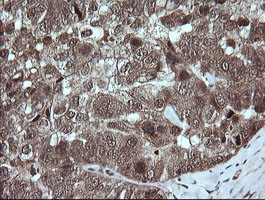 TRMT2A Antibody - IHC of paraffin-embedded Adenocarcinoma of Human ovary tissue using anti-TRMT2A mouse monoclonal antibody.