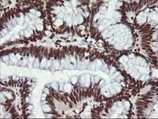 TRMT2A Antibody - IHC of paraffin-embedded Adenocarcinoma of Human colon tissue using anti-TRMT2A mouse monoclonal antibody.