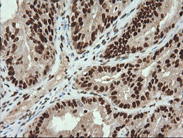 TRMT2A Antibody - IHC of paraffin-embedded Adenocarcinoma of Human ovary tissue using anti-TRMT2A mouse monoclonal antibody.