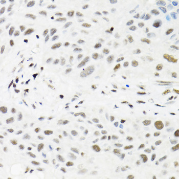 TRMT2A Antibody - Immunohistochemistry of paraffin-embedded human lung cancer tissue.