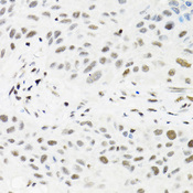 TRMT2A Antibody - Immunohistochemistry of paraffin-embedded human lung cancer tissue.