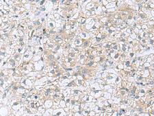 TRO / Trophonin Antibody - Immunohistochemistry of paraffin-embedded Human liver cancer tissue  using TRO Polyclonal Antibody at dilution of 1:80(×200)