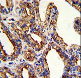 TROP2 / TACSTD2 Antibody - Formalin-fixed and paraffin-embedded human prostate carcinoma with TROP2 Antibody , which was peroxidase-conjugated to the secondary antibody, followed by DAB staining. This data demonstrates the use of this antibody for immunohistochemistry; clinical relevance has not been evaluated.